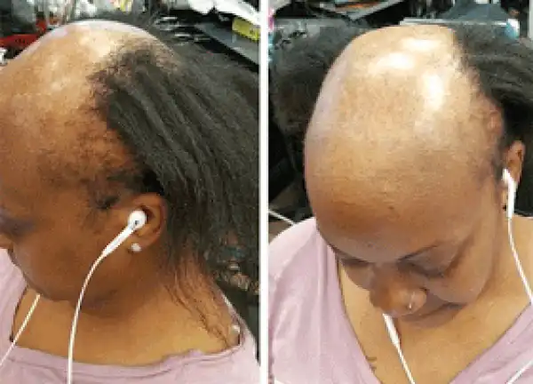 Amazing! See how hairstylist transformed balding woman